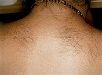 unwanted back hair before laser hair removal