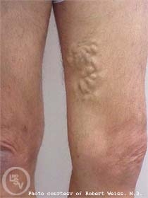 varicose veins before