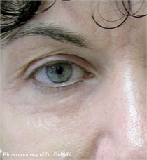 periorbital wrinkles after ActiveFX