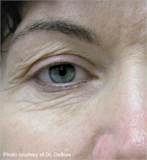 periorbital wrinkles before ActiveFX