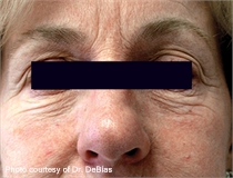 periorbital wrinkles before ActiveFX