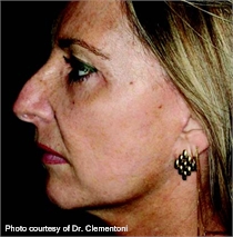 Wrinkles pigmented skin after ActiveFX