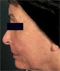 Deep facial wrinkles after DeepFX