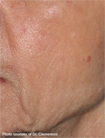 Deep facial wrinkles after DeepFX