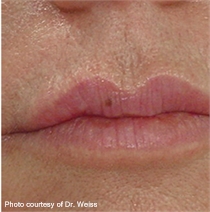 wrinkled lips after DeepFX