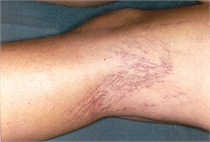 Leg veins before laser treatment