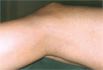 Leg veins after laser treatment