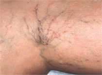 Leg veins before laser treatment