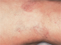 Leg veins after laser treatment