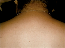 unwanted back hair after laser hair removal