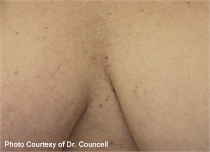 unwanted chest hair after laser hair removal