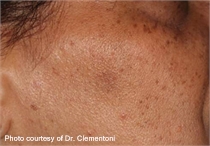 Lentigo after laser treatment