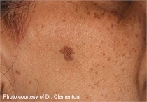 Lentigo before laser treatment