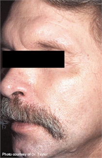 Rosacea after lumenis one laser treatment