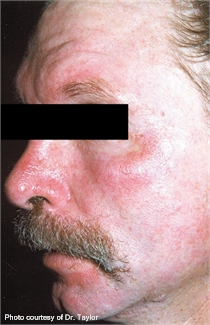 Rosacea before lumenis one laser treatment