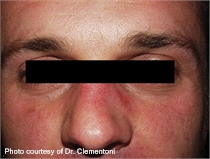 Rosacea before lumenis one laser treatment