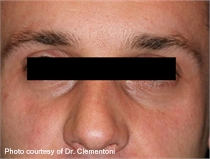 Rosacea after lumenis one laser treatment