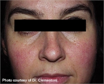 Rosacea before lumenis one laser treatment