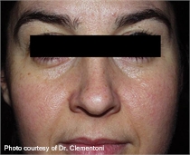 Rosacea after lumenis one laser treatment