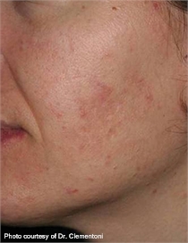 Rosacea after lumenis one laser treatment