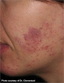 Rosacea before lumenis one laser treatment