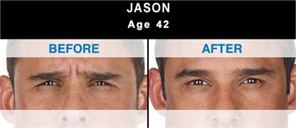 Fine lines and wrinkles Before and After