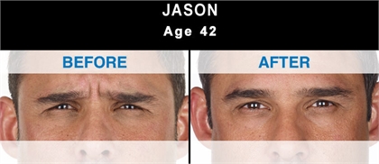 Xeomin Before and After