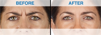 Fine lines and wrinkles Before and After