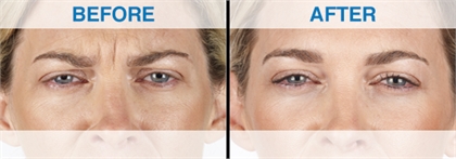 Xeomin Before and After