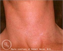 rosacea after