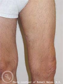 varicose veins after